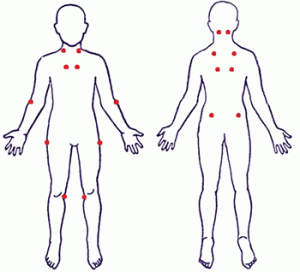 Fibromyalgia Syndrome - Fibro Tender Points